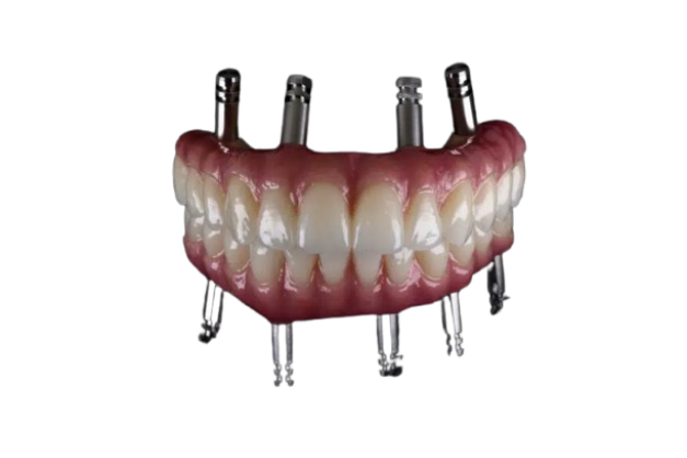 Delivery of Definitive Prosthesis
