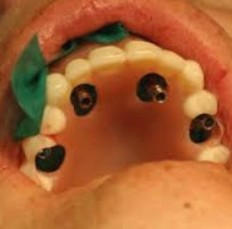 Implant Surgery