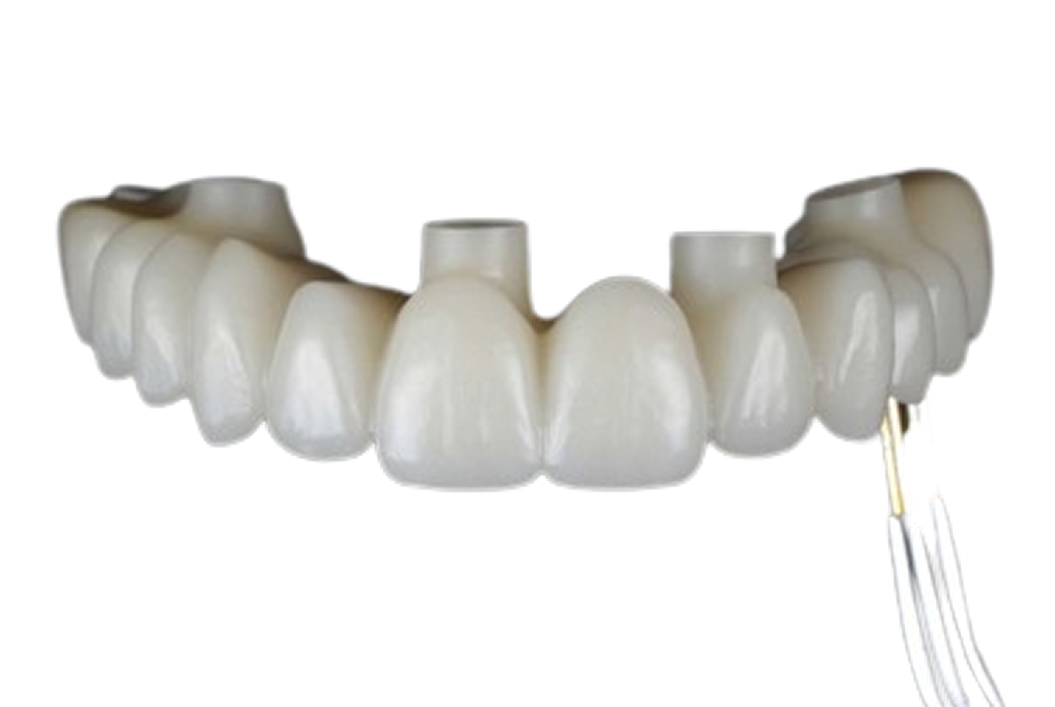 Immediately Loaded Prosthesis